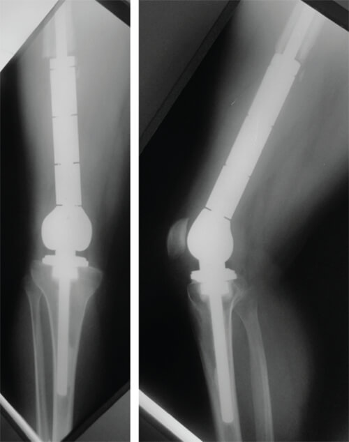 Figura 6. Radiografía anteroposterior (izquierda) y lateral (derecha) a 36 meses del post operatorio.