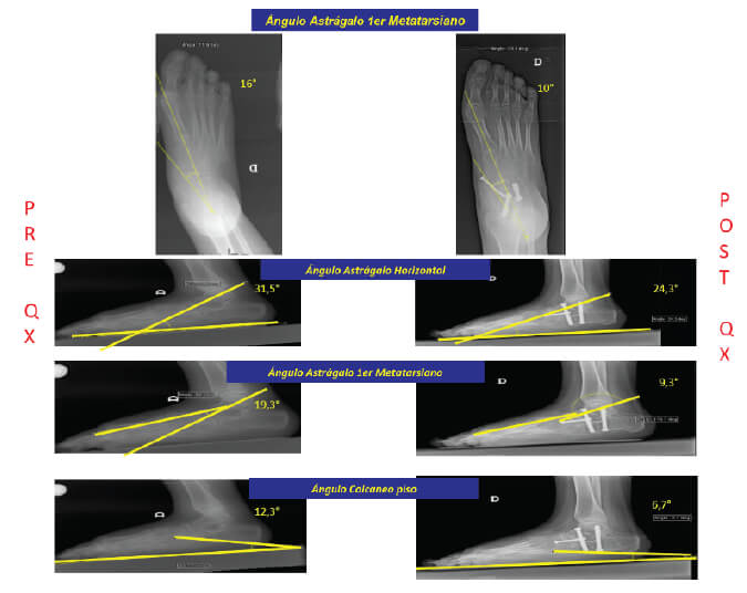 Fig. 2. Radiografías AP y LAT con apoyo pre y post quirúrgico.