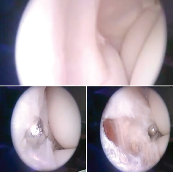 Figura 3. Exploración artroscópica del codo. Revisión de compartimiento en busca de patologías asociadas. Imágenes inferiores muestran desbridamiento capsular y de zona afecta de extensor corto de carpo hasta visualizar fibras muscularesde supinador largo.