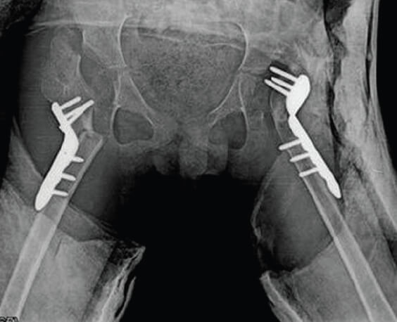 Figura 1. Radiografía Anteroposterior de procedimiento de McHale bilateral de cadera en masculino de 12 años.