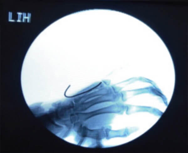 Figura 3. Enclavijado anterogrado bajo fluoroscopia. Proyección oblicua.