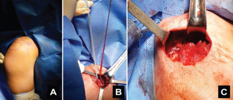 Figura 1. Técnica quirúrgica. A: Reparos anatómicos; B: Paso de sutura Fibertape® por debajo de la apófisis coronoides; C: Nudo de sutura sobre la clavícula previa reducción.