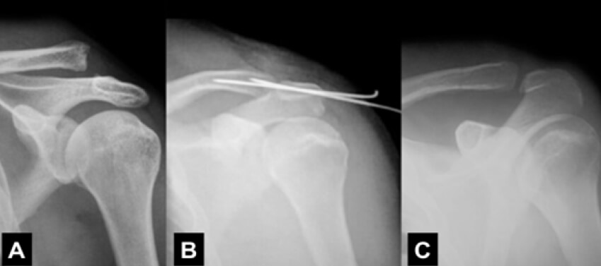 Figura 2. Técnica quirúrgica. Imágenes radiológicas: A: Pre-operatorias; B: Post-operatoria 6 semanas; C: Post-operatorias 12 semanas.