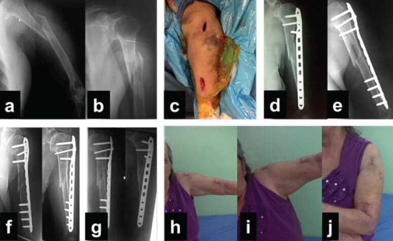 Figura 1. Caso clínico, paciente femenino de 81 años con fractura AO/ASIF 11A1.1 IC1MT1NV2. 1a y 1b: Radiografías preoperatorias; 1c: Incisiones lateral proximal y distal anterior; 1d y 1e: Radiografías del postoperatorio inmediato; 1f: Postoperatorio 8 semanas; 1g: Postoperatorio 16 semanas; 1h, 1i y 1j: Resultados clínicos 16 semanas.