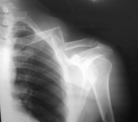 Figura 1. Radiografía anteroposterior de hombro izquierdo proyección anteroposterior al momento del ingreso.