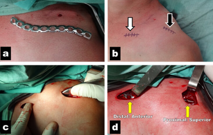 Figura 3. a: Preparación para establecer localización de incisiones de acuerdo a longitud de la placa. b: Incisión medial y anterior (flecha blanca) e incisión lateral y superior (flecha negra); c: Tunelización con disector; d: Implantación de la placa anterior en el extremo proximal y superior en el extremo distal (flechas).