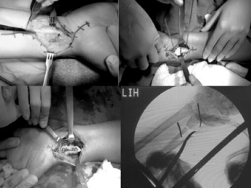 Figura 2. Técnica Quirúrgica: Osteotomía.