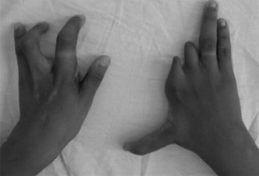 Figura 1. Fotos clínicas de ambas manos.
