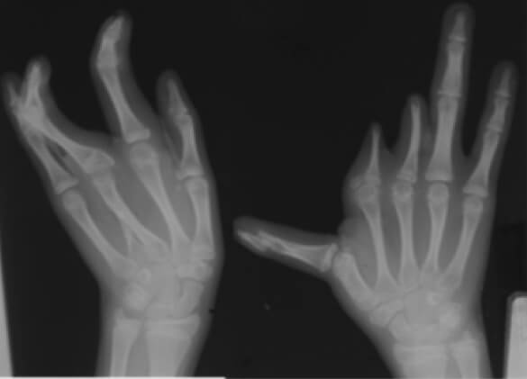 Figura 3. Radiografía anteroposterior de ambas manos.