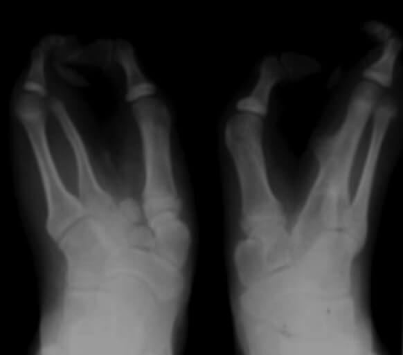 Figura 4. Radiografía anteroposterior de ambos pies.