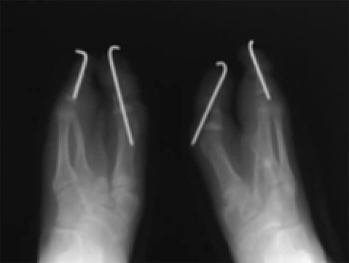 Figura 5. Radiografía anteroposterior post operatorias de ambos pies.
