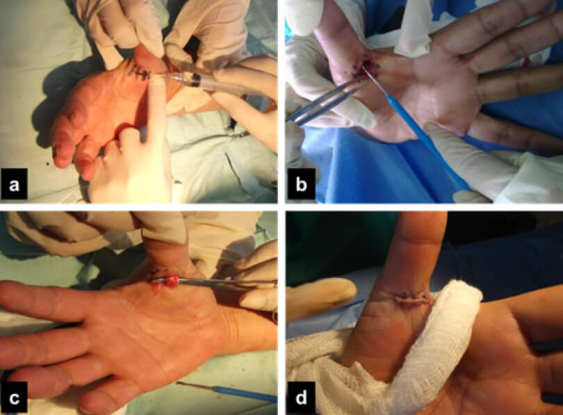 Figura 2. Técnica Quirúrgica: a) Colocación de anestesia local y adrenalina; b) Corte de la polea A1; c) Comprobación de la liberación; y d) Cierre de la herida.