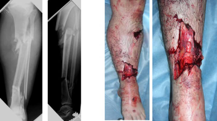 Figura 1 y 2. Izquierda: Radiografía anteroposterior y lateral de la pierna de ingreso. Derecha: Estado de partes blandas.