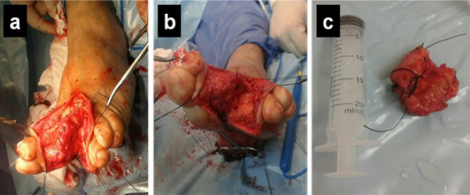 Figura 1. Fotos clínicas del transoperatorio: Incisión (a y b); y lesión (c).
