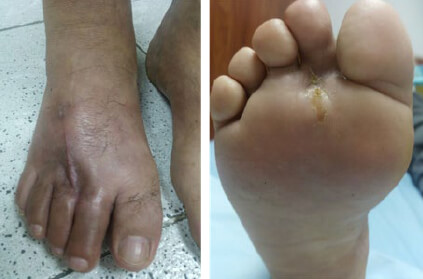 Figura 2. Dorso y planta del pie derecho, 6 meses de post operatorio.