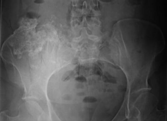 Figura 1. Radiografía anteroposterior de pelvis a su ingreso.