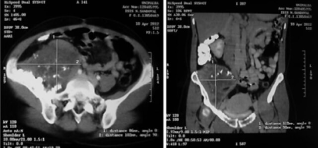 Figura 2. Imágenes de TC en sus cortes axial (izquierda) y coronal (derecha).