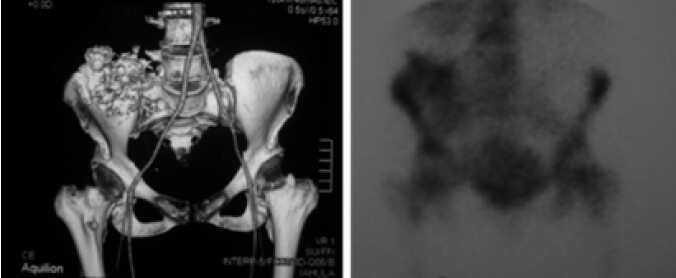 Figura 3. Imágenes de reconstrucción 3D de la TC (izquierda) y del gammagrama óseo (derecha).
