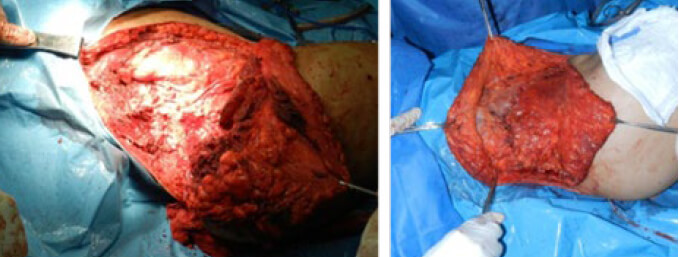 Figura 4. Fotos clínicas del transoperatorio antes (izquierda) y después de la resección de la lesión (derecha).