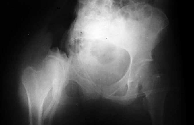 Figura 5. Radiografía anteroposterior de la pelvis post operatoria.