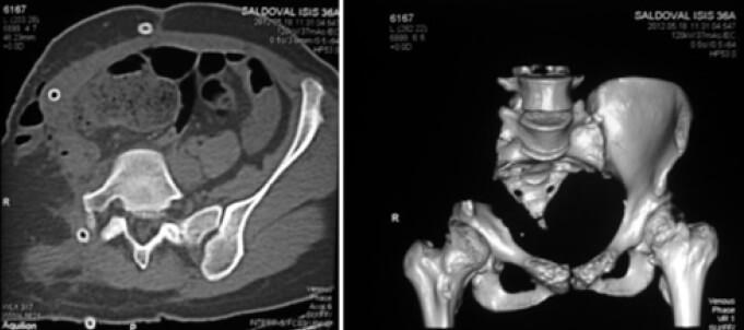 Figura 6. Imágenes de la TC en su corte axial (izquierda) y de reconstrucción 3D (derecho) postoperatorias.