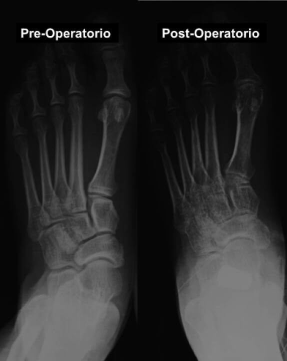 Figura 3. Radiografía anteroposterior de pie derecho pre y post-operatorio