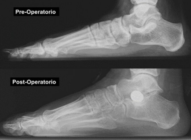 Figura 4. Radiografía Lateral de pie derecho pre y post-operatorio