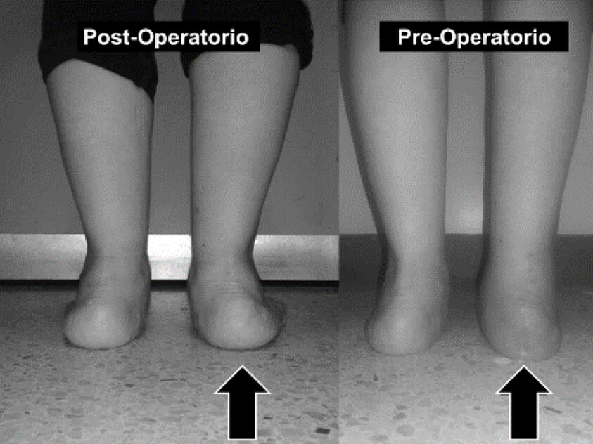 Figura 5. Imagen clínica de la corrección del valgo pre-operatorio del retropié derecho