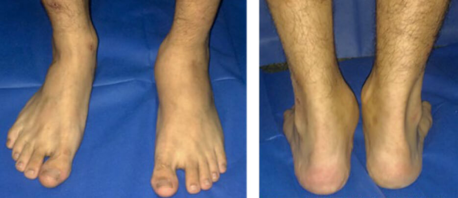 Figura 1. Fotos clínicas de frente y posterior de ambos pies. Nótese el aumento de volumen en mediopié y la desviación en valgo de retropié izquierdo.