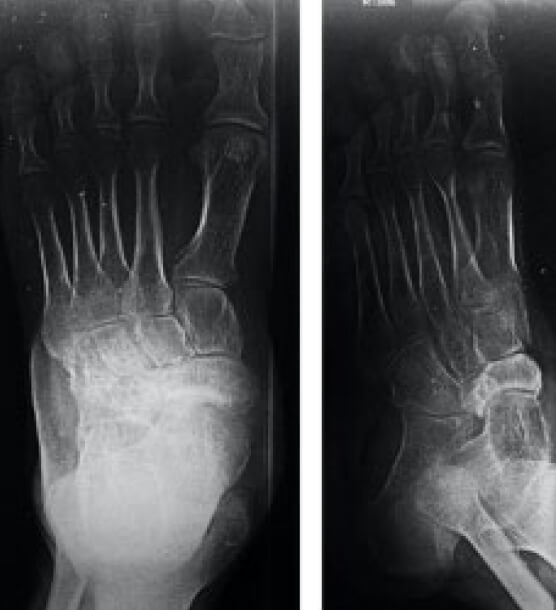 Figura 2. Radiografías anteroposterior y oblicua de pie izquierdo sin carga. Se puede evidenciar a nivel del Hueso Navicular cambios escleróticos y bordes irregulares en cortical de cara lateral