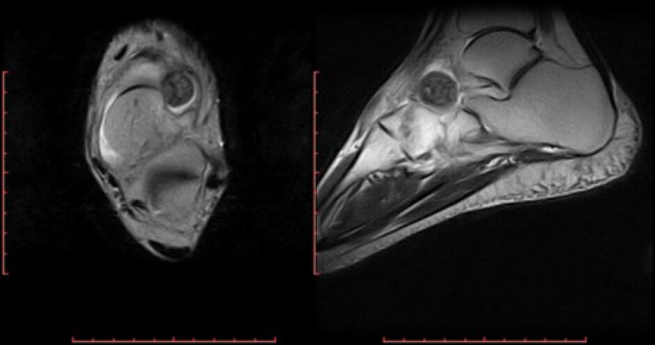 Figura 3. Corte axial (izquierda) y sagital (derecha) en Resonancia Magnética Nuclear imágenes potenciadas en T2. Destaca la forma ovalada de la lesión con Halo Hipertenso alrededor de área Hipointensa.