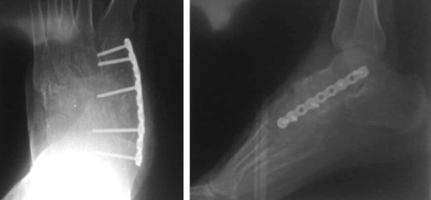 Figura 5. Imágenes de radiografías 8va semana post operatorio. Se evidencia velamiento parcial de las líneas articulares en articulación talo navicular y navícula cuneiforme.