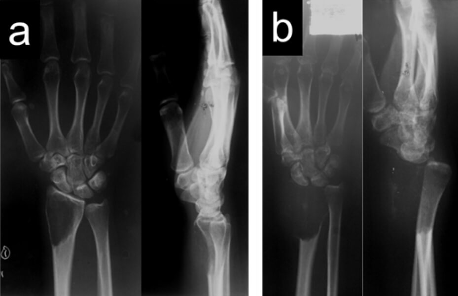 Figura 1. Radiografías posteroanterior y lateral de muñeca derecha al momento del diagnóstico (a) y después de 3 meses de evolución (b).