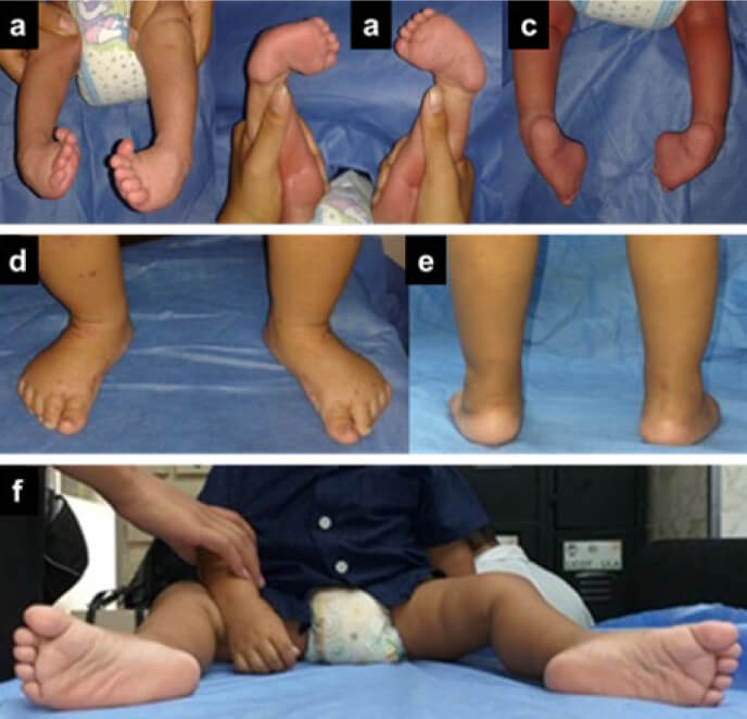 Figura 1. Imágenes clínicas antes de la aplicación del Método Ponseti (a, b y c) y en la evaluación final (d, e y f) de uno de los pacientes de nuestro estudio.