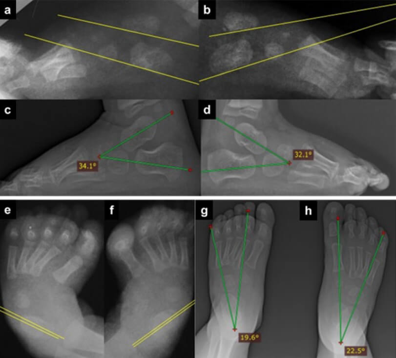 Figura 2. Imágenes radiológicas anteroposterior y lateral de los pies, previas (a, b, e y f) y posteriores (c, d, g y h) a la aplicación del Método Ponseti.