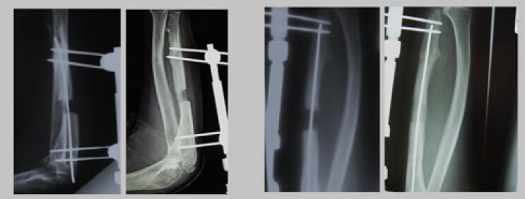 Figura 1. Casos de Osteocondromatosis con acortamiento cubital que requirieron elongación ósea.