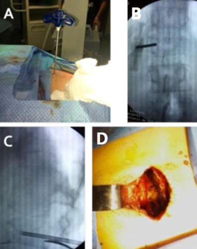 Figura 2. Imágenes del intra-operatorio. A.
Colocación de punzón para toma de muestras.
B. Intensificador de imágenes con localización
del punzón. C. Toma de muestras guiada por
intensificador de imágenes. D. Descompresión
de canal medular.