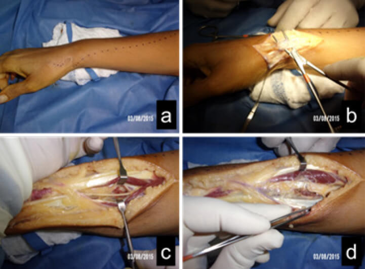 Figura 1. Fotos clínicas del intraoperatorio.