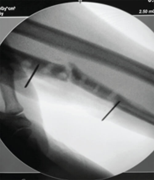 Figura 1. Imagen intraoperatoria de intensificador de imágenes, delimitando con alambres de Kirschner el área de hueso para la ostectomía.