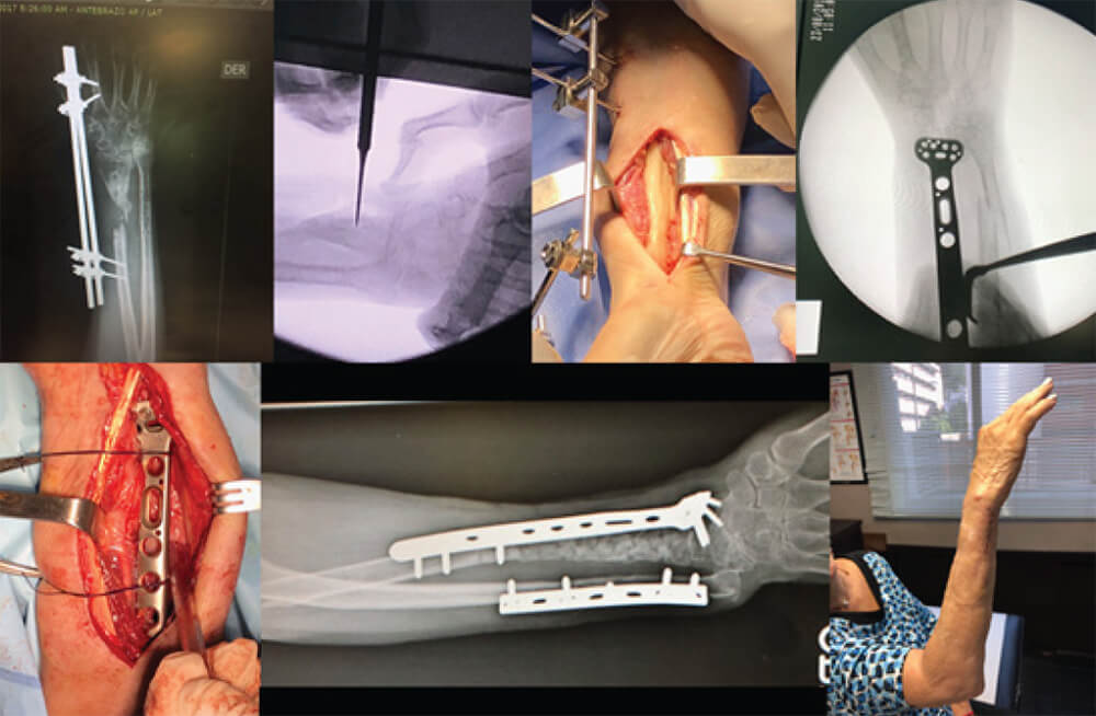 Figura 5. Caso #/14. Paciente femenino de 61 años. Pseudoartrosis infectada de tercio medio con distal de radio derecho. Protocolo de membrana inducida y osteosíntesis con placa bloqueada anatómica de radio distal. Resultados radiológicos y clínicos.