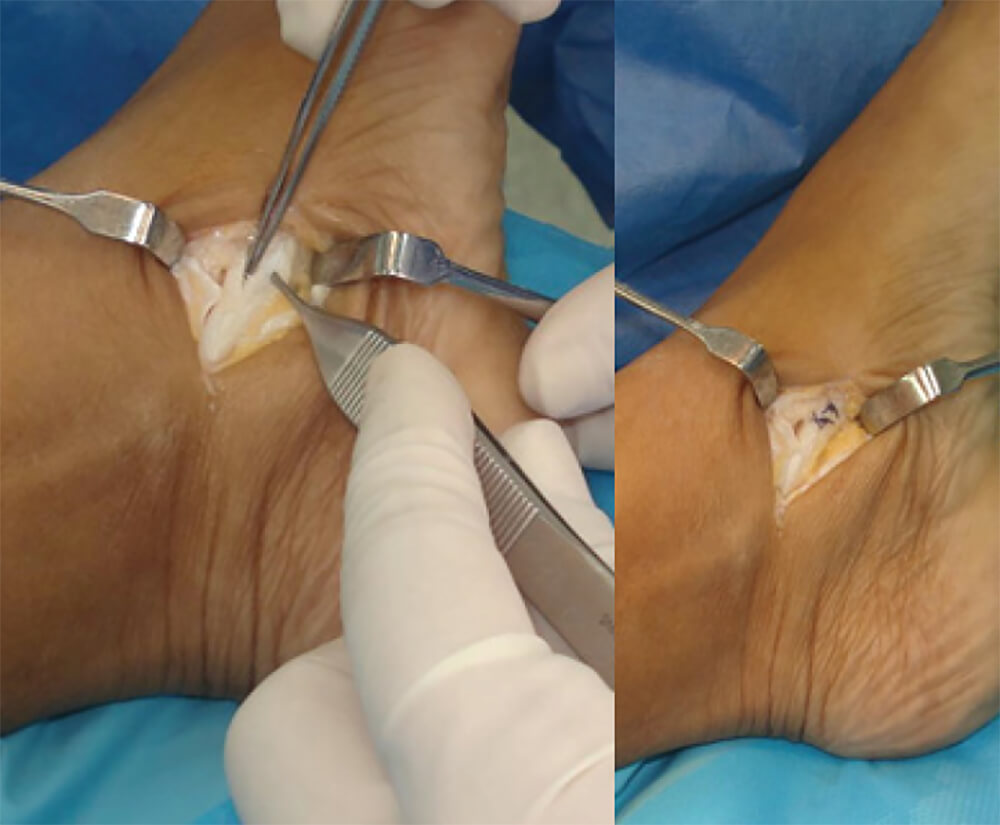 Figura 6 y 7. Técnica quirúrgica: Apertura y reparación de la vaina del tendón.