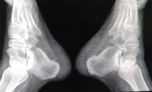 Figura 1. Radiografía de ambos calcáneos en lateral 26-noviembre 2019.