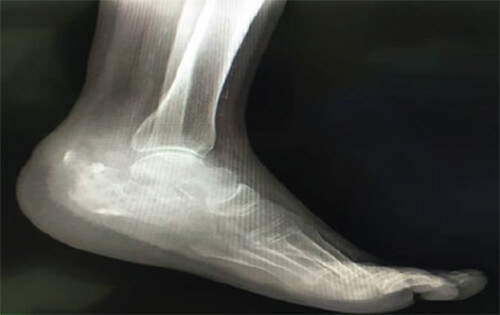 Figura 2. Radiografía lateral de pie izquierdo diciembre 2020.