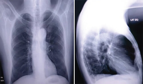 Figura 3. Radiografía de tórax AP y Lateral.