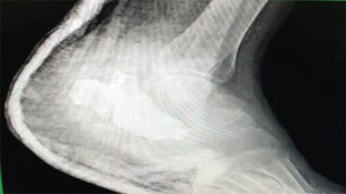 Figura 4. Radiografía postquirúrgica 22-01-2021