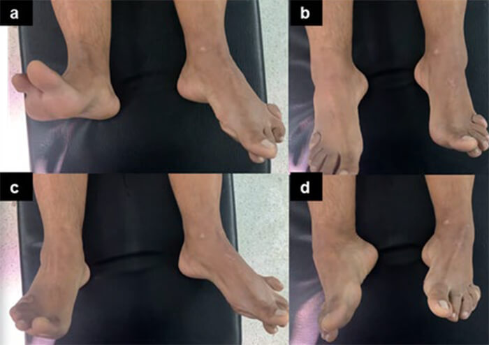 Figura 1. Imágenes clínicas donde se evidencia el examen físico del paciente: A: Dorsiflexión, B: Plantiflexión, C: Eversión. D: Inversión.