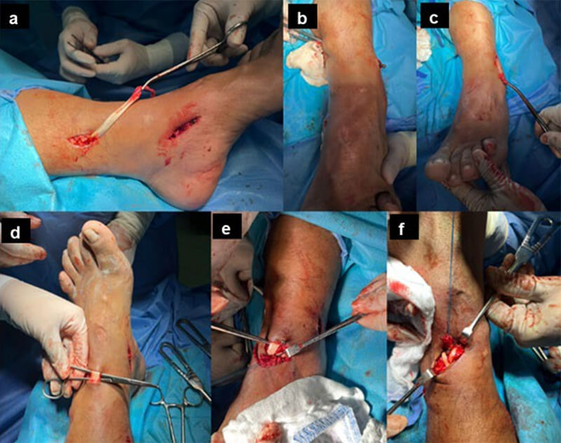 Figura 2. Imágenes intraoperatorias. A: Extracción del tibial posterior en el 2do abordaje. B y C: Paso del tendón tibial posterior a través de membrana interósea. D: 3er abordaje, donde se evidencia el tibial anterior. E y F: Tenodesis del Tibial posterior al Tibial anterior.