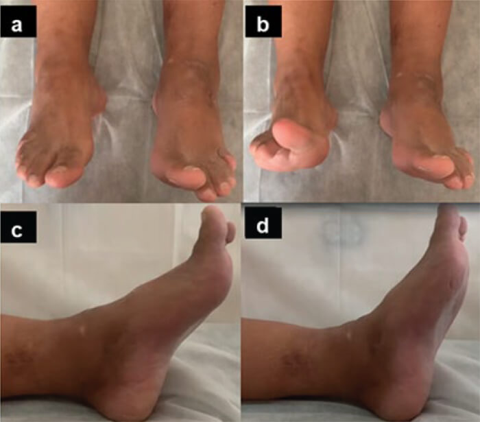 Figura 3. Examen físico: Visión frontal: A: Plantiflexión. B: Dorsiflexión. Visión sagital: C: Plantiflexión. D: Dorsiflexión.