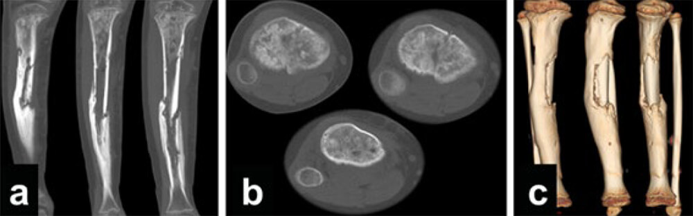 Figura 2. La TAC en sus cortes coronales (a), axiales (b) y reconstrucción 3D, demuestra engrosamiento anormal del hueso cortical afectado, cambios escleróticos, invasión de la cavidad medular, interrupción de la continuidad de la cortical, trayectos fistulosos y secuestros.