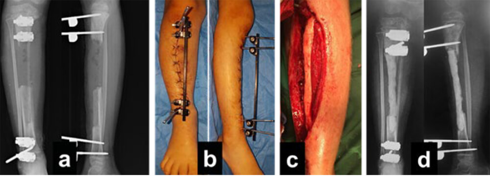 Figura 3. (a) Radiografías post operatorias; (b) Fotos clínicas postoperatorias; (c) Imágenes del intraoperatorio donde se muestra la implantación del cemento óseo; (d) Radiografías postoperatorias.